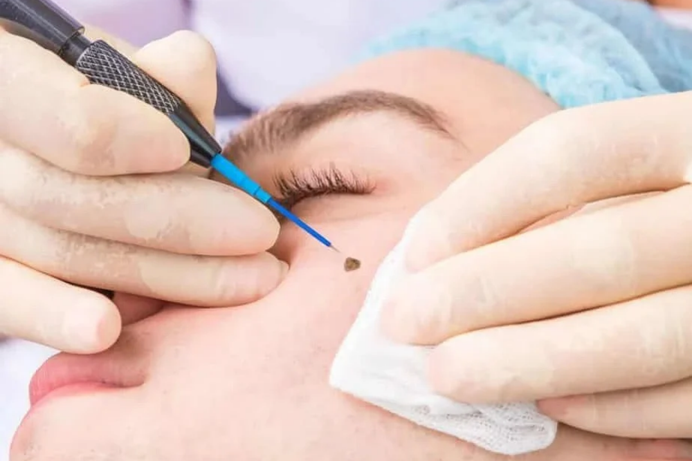 Mole Removal