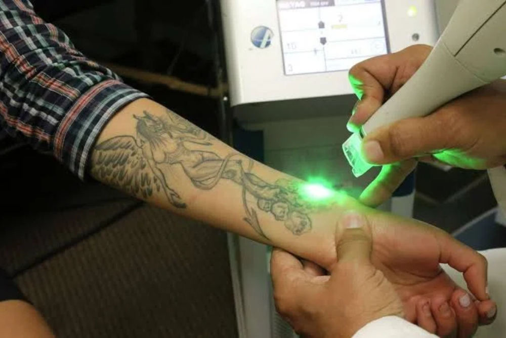 Laser Tattoo Removal